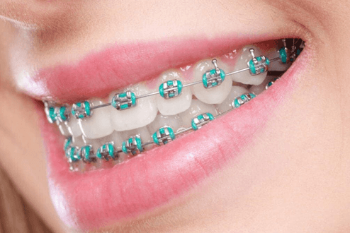 What are the different types of braces?