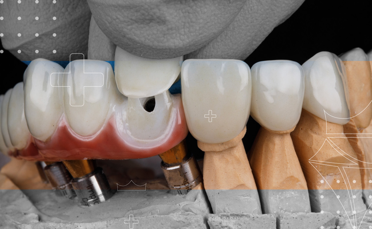 SaphireDent-Bone-Grafting-03