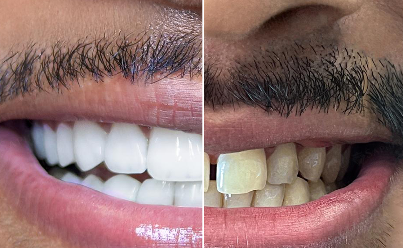 SaphireDent-Veneers-02