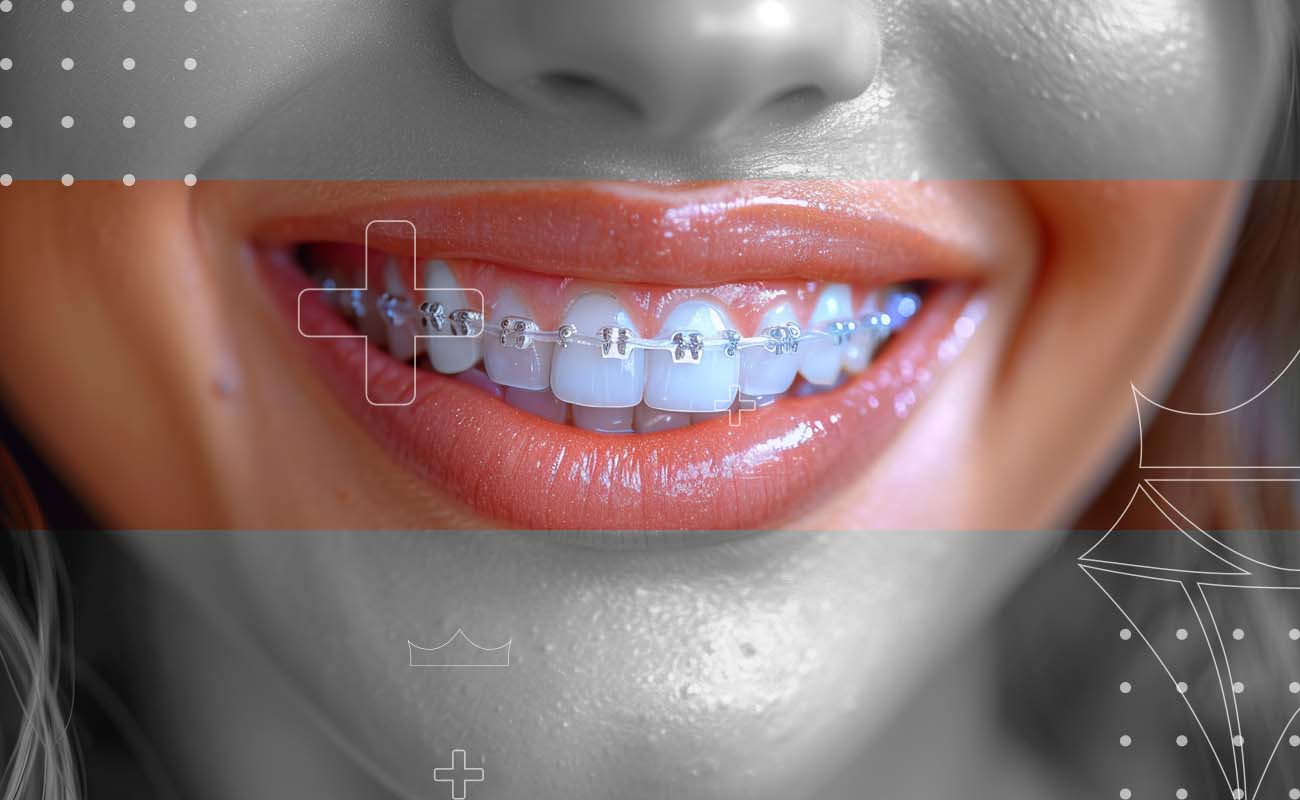 SaphireDent-CeramicBraces