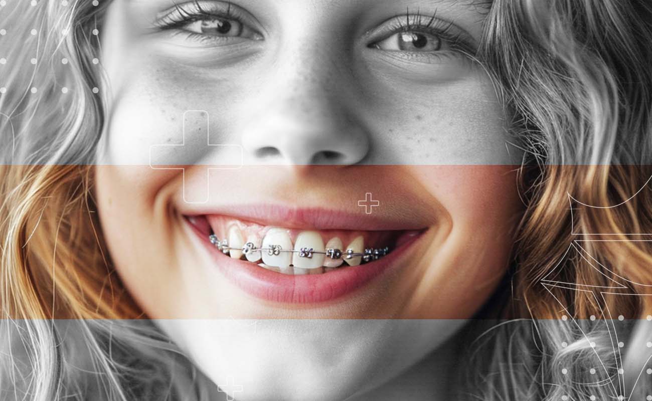 SaphireDent-MetalBraces