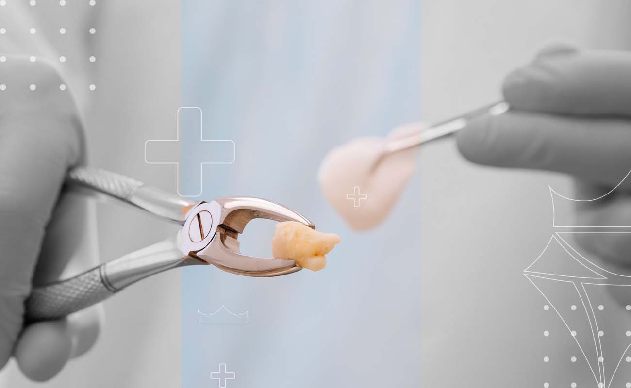 SaphireDent-Tooth-Extraction-02