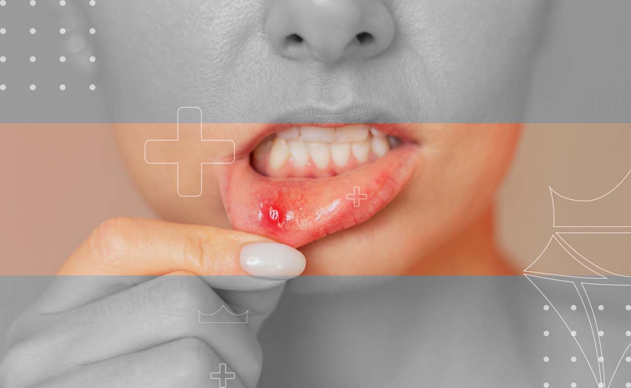 SapireDent-Aphthous-Ulcer-Herpes-Treatment