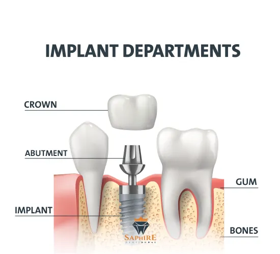Dental Implants Dental Implants